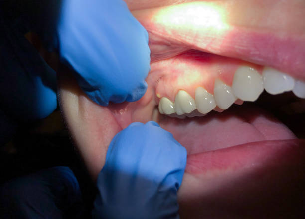 Best Emergency Wisdom Teeth Removal in Leander, TX
